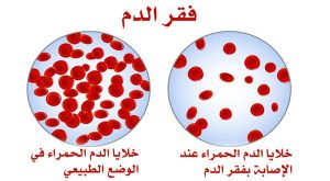 كيف أعالج فقر الدم