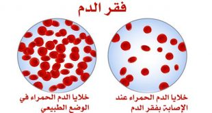 اعراض مرض فقر الدم